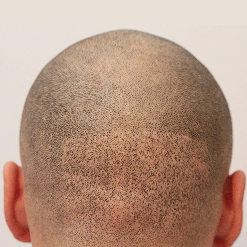 Scalp micropigmentation camouflaging scars and alopecia patches for a seamless look at MC Scalp, UK.