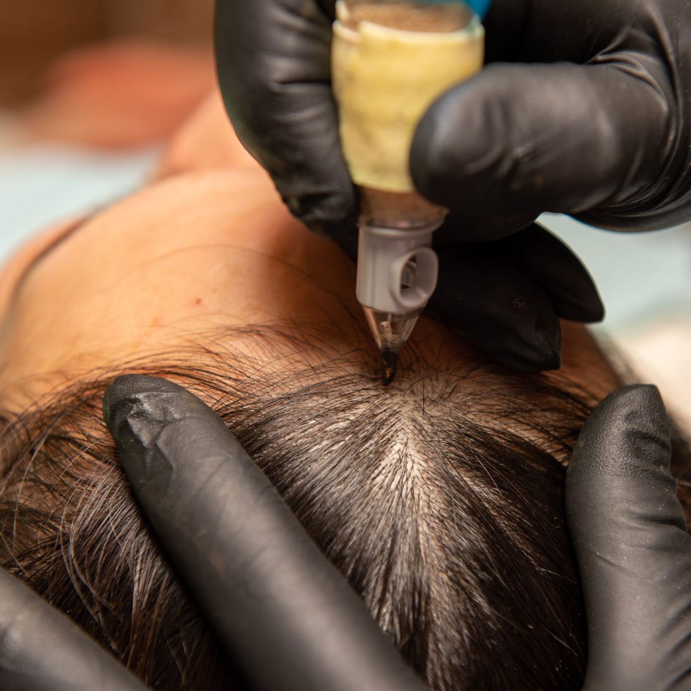 Scalp micropigmentation treatment for women, adding the appearance of density to thinning hair at MC Scalp, UK.