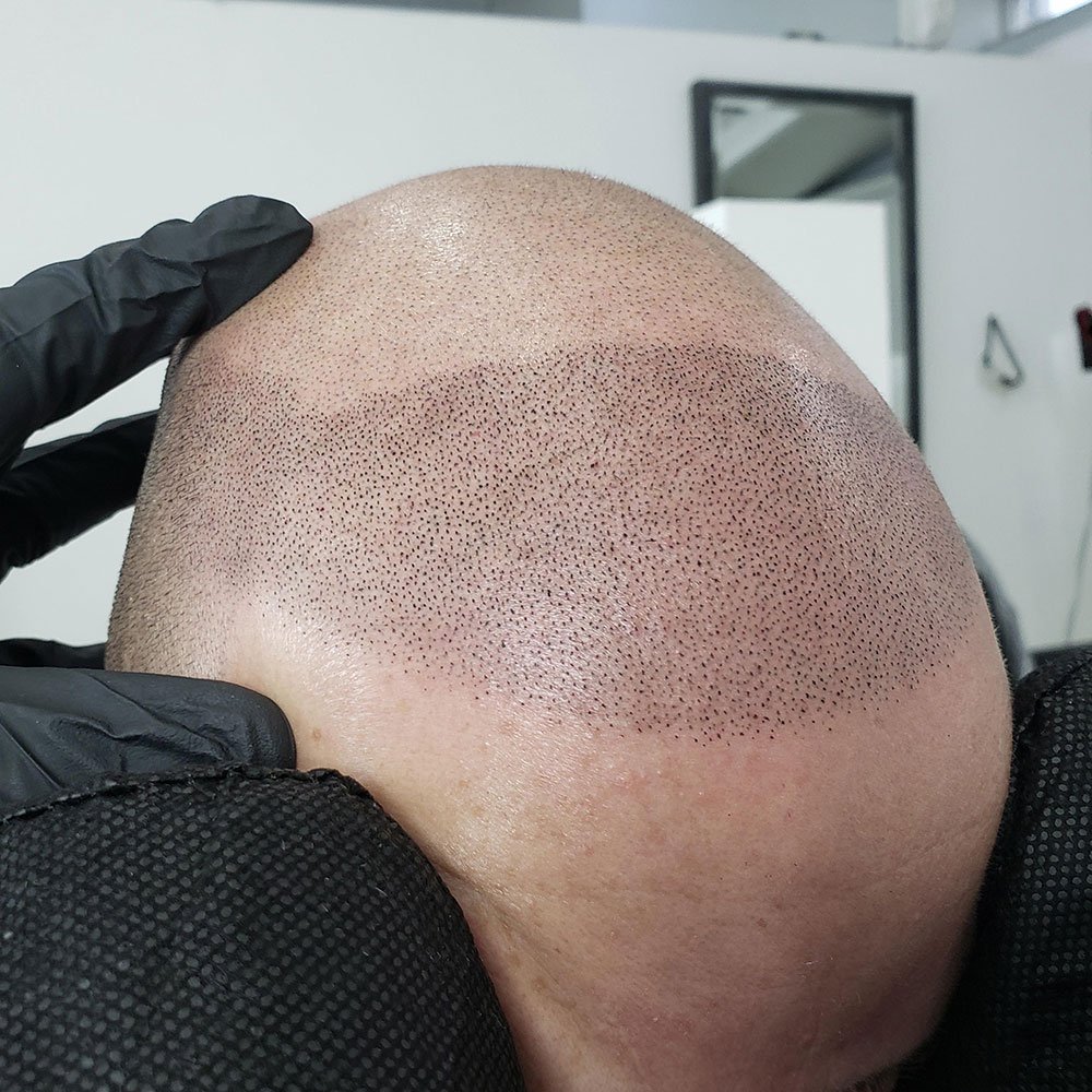 Scalp micropigmentation treatment creating the appearance of a fuller hairline at MC Scalp in the UK.