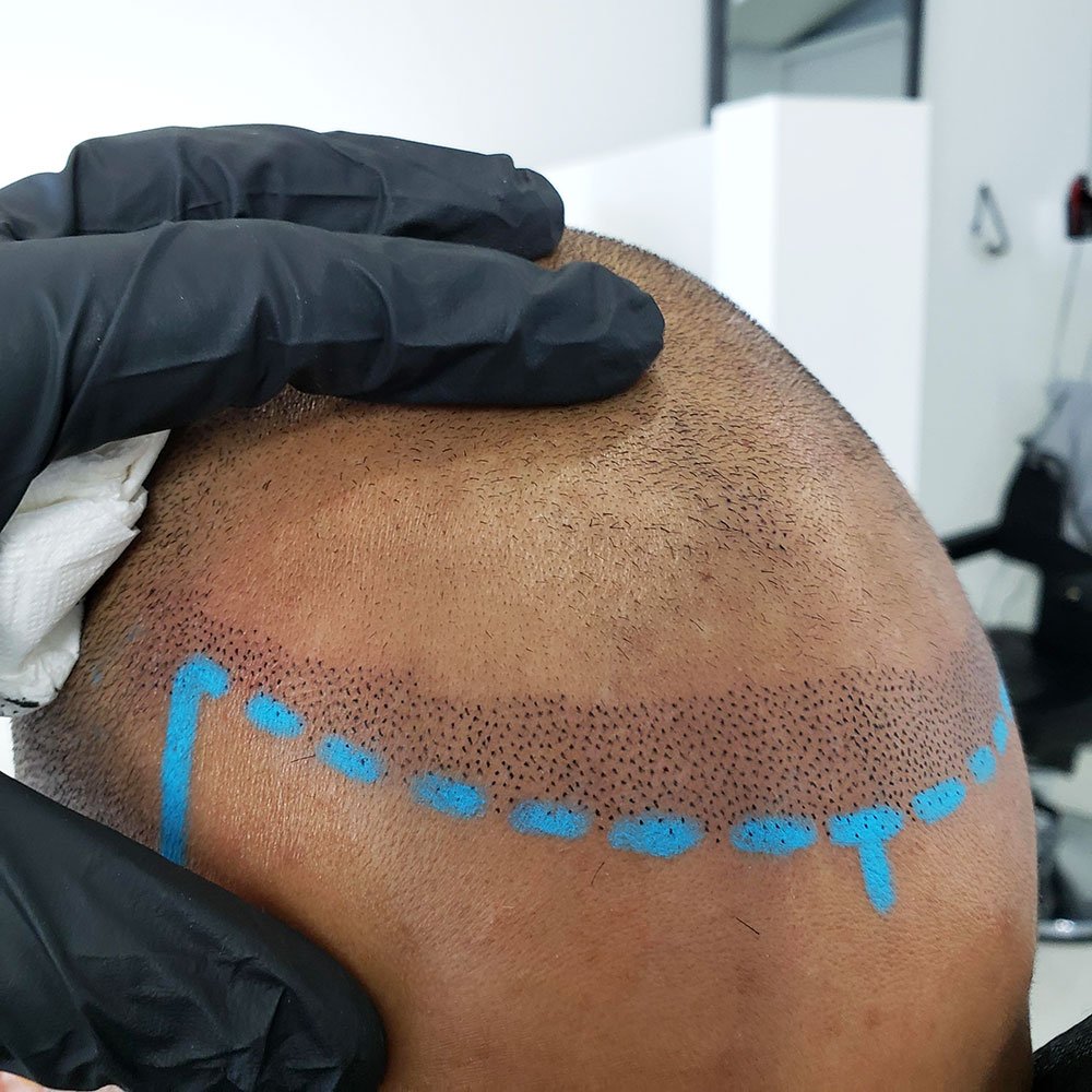Scalp micropigmentation treatment for men, restoring the look of a full buzzed hairline at MC Scalp, UK.