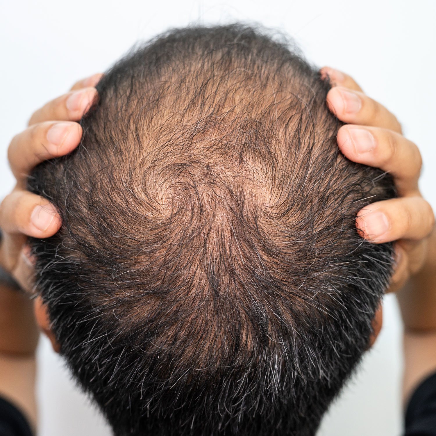 Scalp micropigmentation treatment for density, enhancing the look of thicker, fuller hair at MC Scalp in the UK.