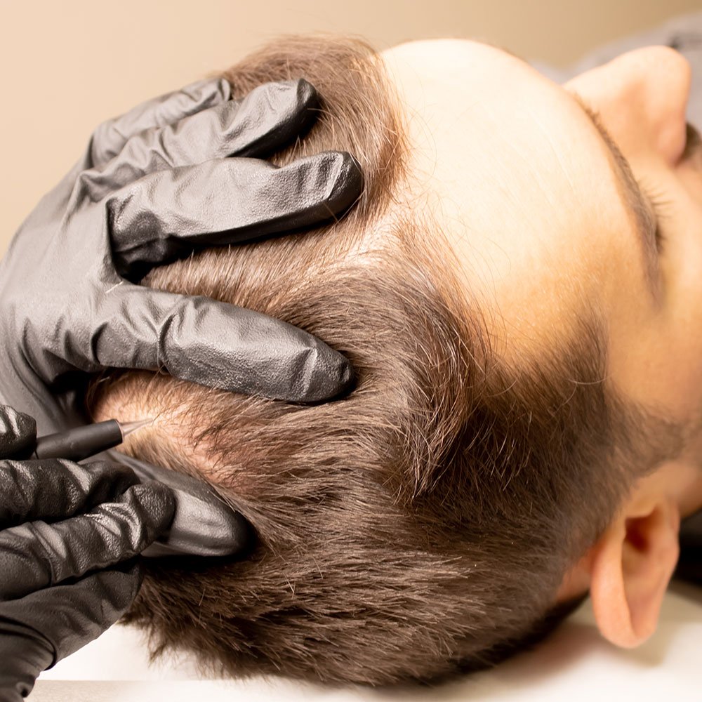 Scalp micropigmentation treatment enhancing hair density and reducing the appearance of thinning at MC Scalp, UK.