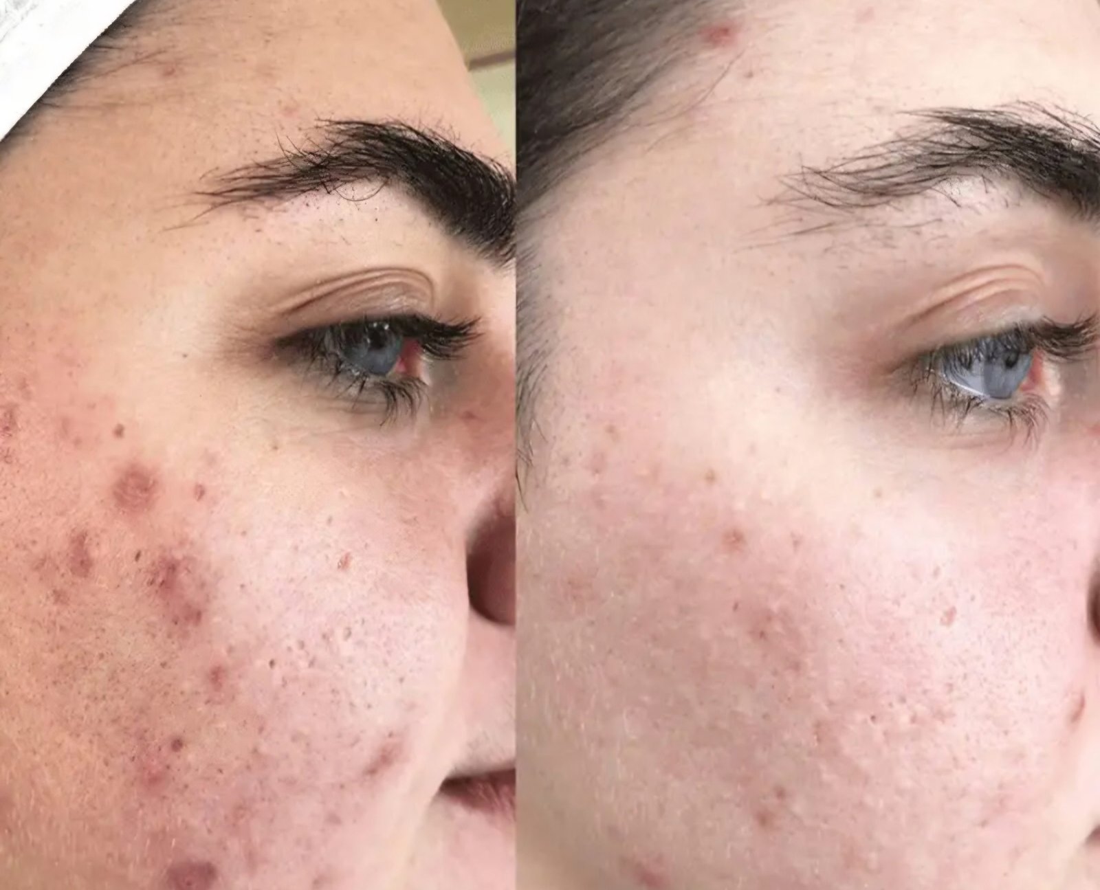 Before and after plasma pen treatment showing visible skin rejuvenation and tightening results at MC Scalp.