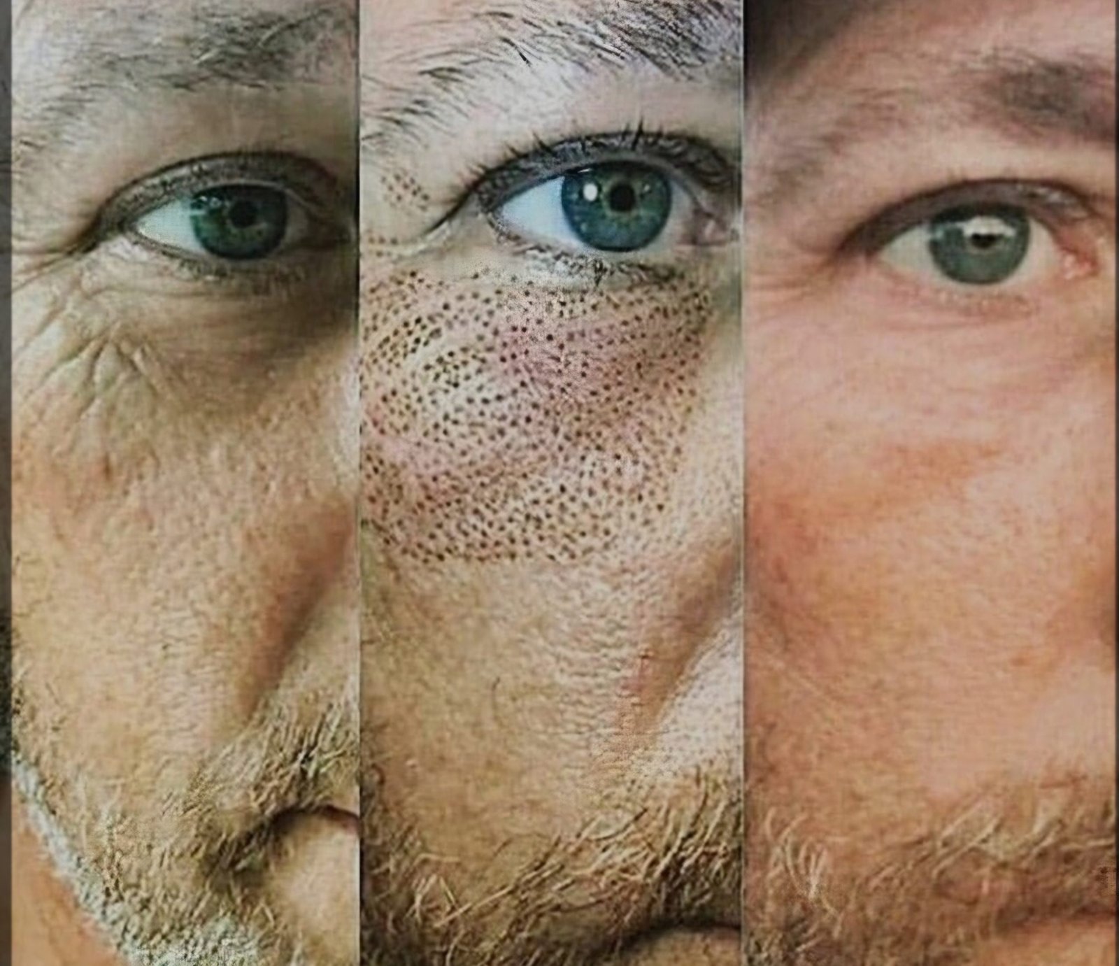 Before, during, and after plasma pen treatment photo at MC Scalp, showing skin tightening and rejuvenation results.